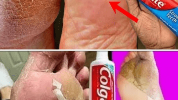 10 Early Signs of High Blood Pressure You Might Be Ignoring Every Day