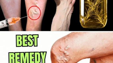 Discover What Your Skin Reveals About Diabetes Before Any Blood Test